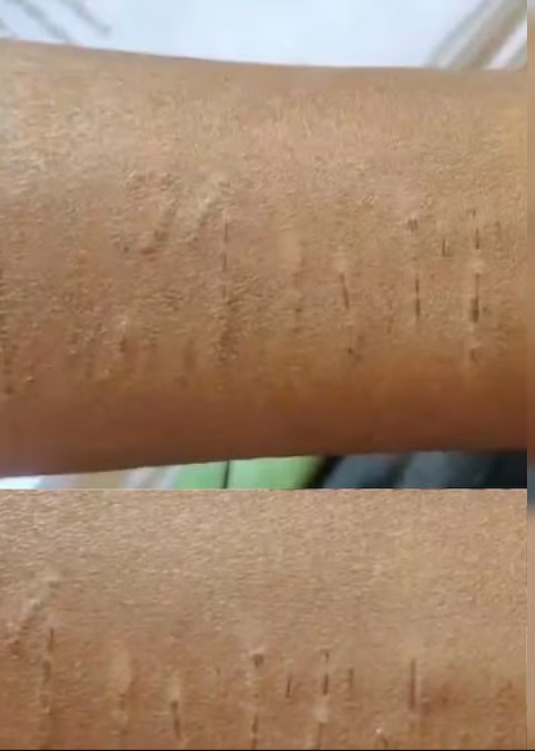 कुरूद: रोगटे खड़े कर देने वाली घटना,दहदहा स्कूल में 35 बच्चों ने 'काटे' हाथ; खुद को पहुंचाया नुकसान एक दूसरे को  किया चैलेंज